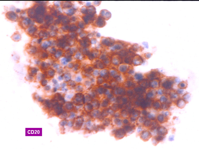 Fig.22: PEL. CD20 - <div style=